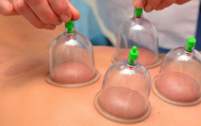 The Science of Cupping (Hijama)