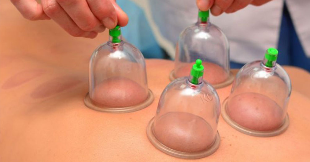 The Science of Cupping (Hijama)